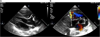 Case report: Transcatheter closure of a giant and tortuous right coronary artery to right ventricle fistula in an infant